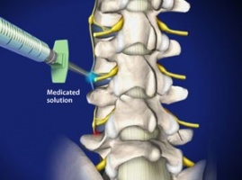 Spine Care of San Antonio Michael S McKee, MD, San Antonio